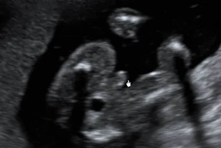 Czy w 16 tygodniu ciąży naprawdę widać płeć dziecka? Sprawdź, co mówią badania USG