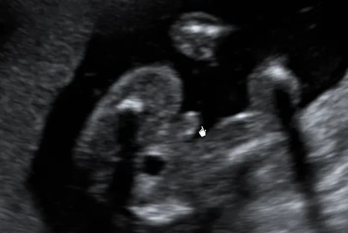 Czy w 16 tygodniu ciąży naprawdę widać płeć dziecka? Sprawdź, co mówią badania USG