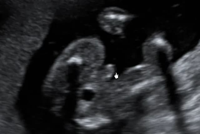 Czy w 16 tygodniu ciąży naprawdę widać płeć dziecka? Sprawdź, co mówią badania USG